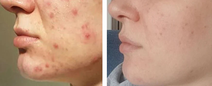 Voorkom de meest gemaakte fout bij acne en puistjes: Waarom crèmes en huidproducten niet werken en het juist ERGER maken